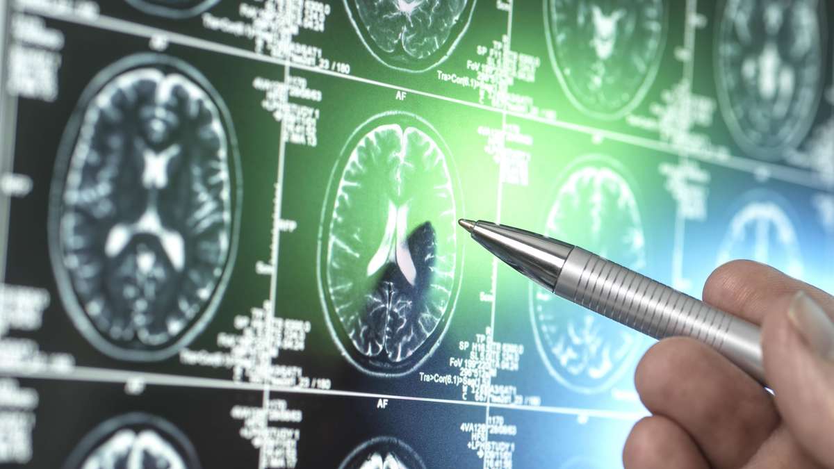 Cinco hábitos diários que podem reduzir o risco de demência em até 40%